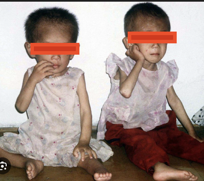 Nạn đói ở Tr!ểu T!ên năm 1990-1999 khiến 240k đến 3tr500k người chớt. Nguyên nhân do Sụp đổ nguồn...