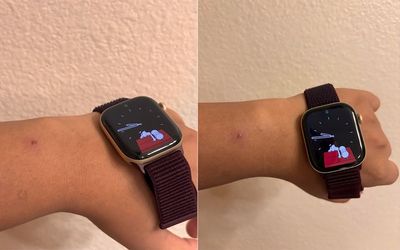 Một số người dùng Apple Watch Series 12 và Ultra 4 phản ánh tình trạng kích ứng da khi đeo các...